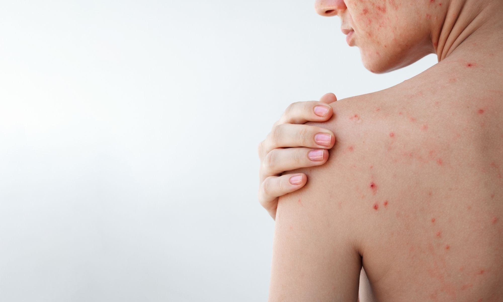A co hormony? Pubertální a dospělé akné nejsou totéž