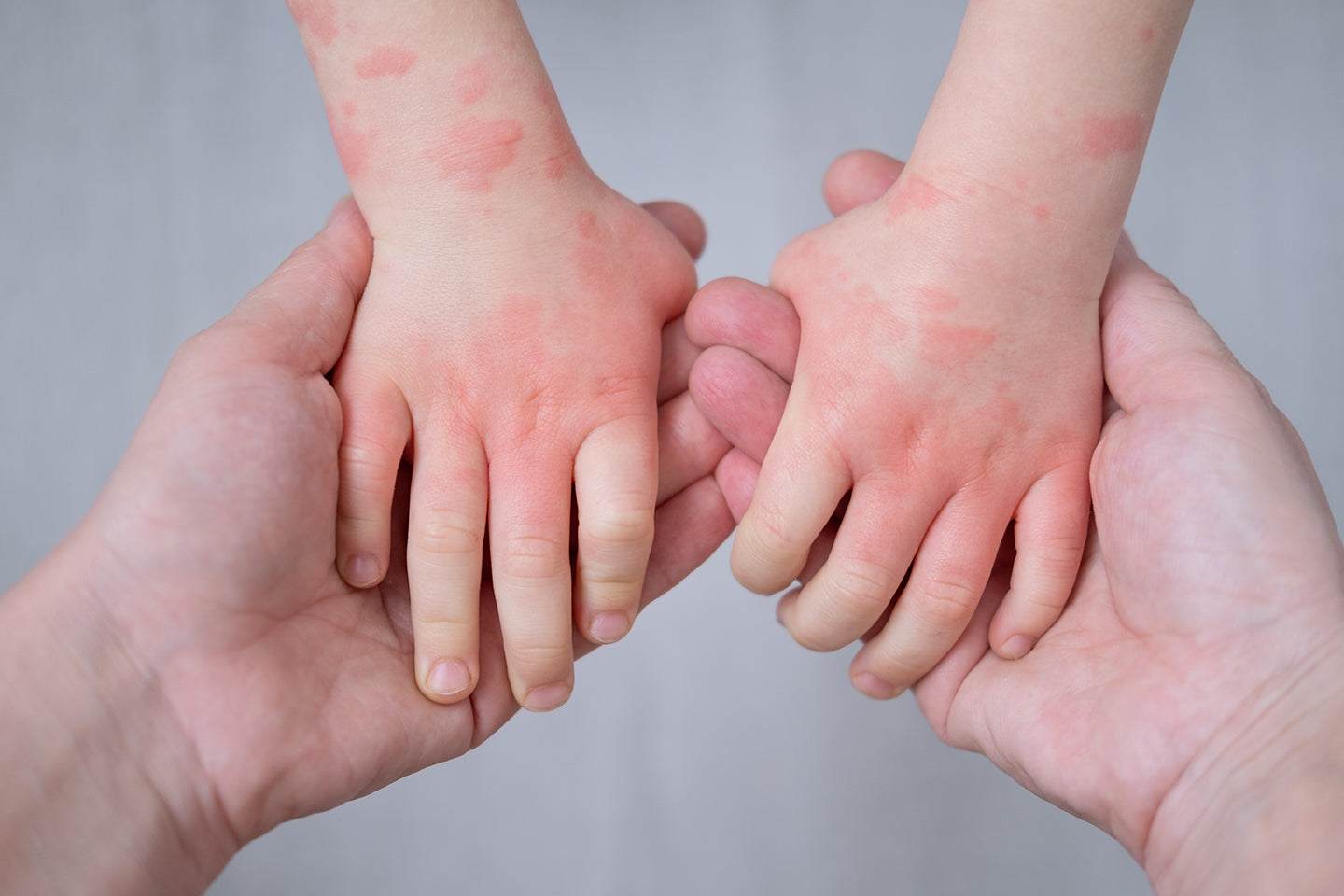 UNDERSTANDING ECZEMA: CAUSES, SYMPTOMS, AND TIPS ON HOW TO TREAT