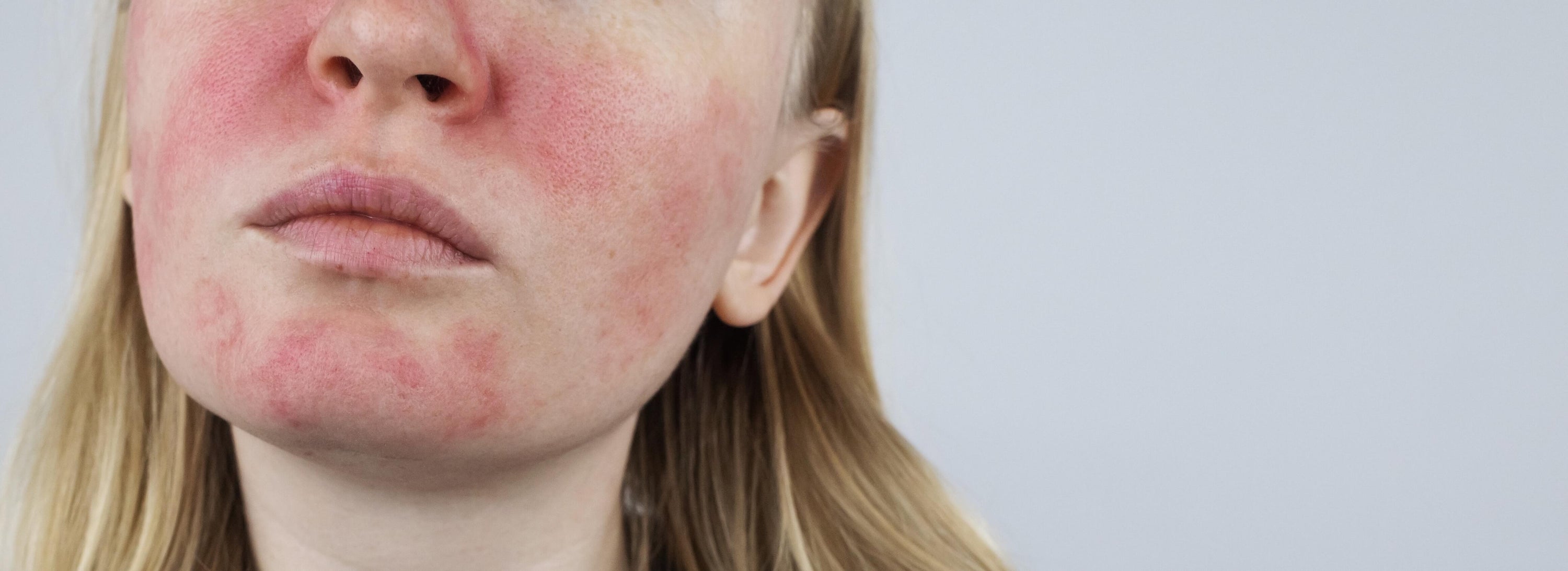 10 ÚČINNÝCH ZPŮSOBŮ, JAK SE ZBAVIT ZARUDNUTÍ V OBLIČEJI