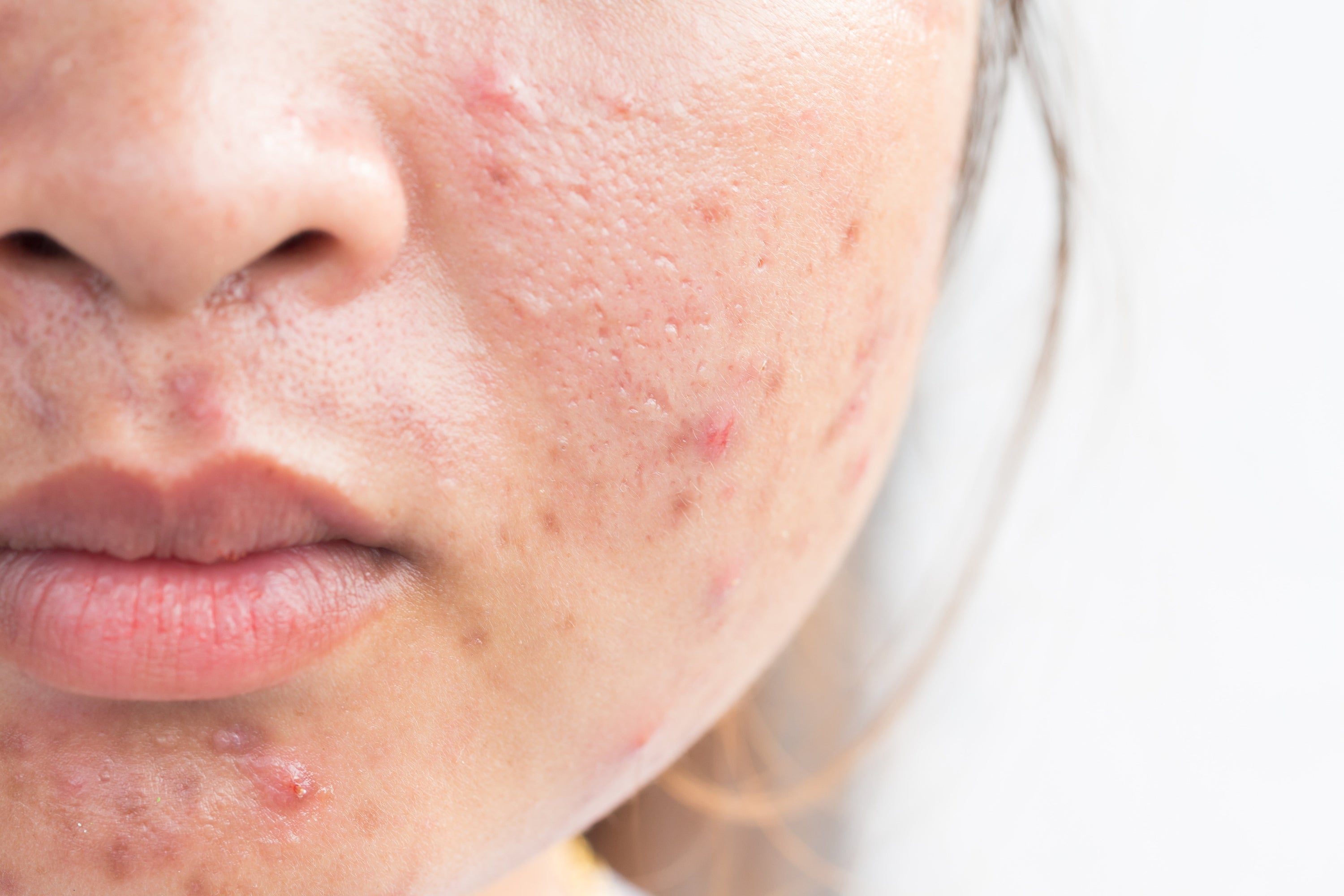 Zdědí vaše dítě akné?