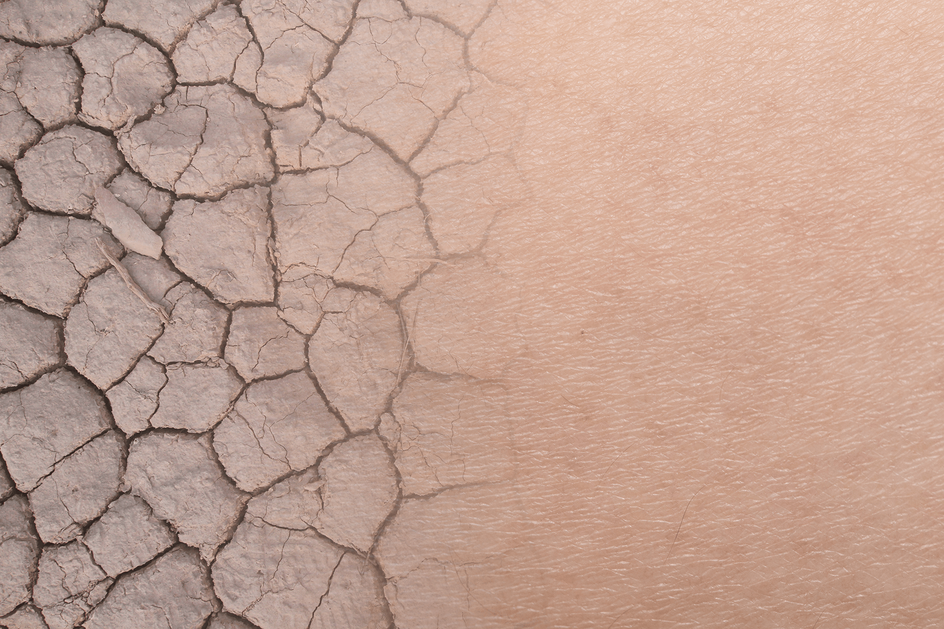 Dry Skin image