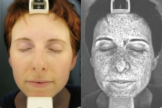 UV světla na kůži. - PŘÍRUČKA PRO PŘEŽITÍ LÉTA: JAK SI PORADIT S CITLIVOSTÍ NA SLUNCE