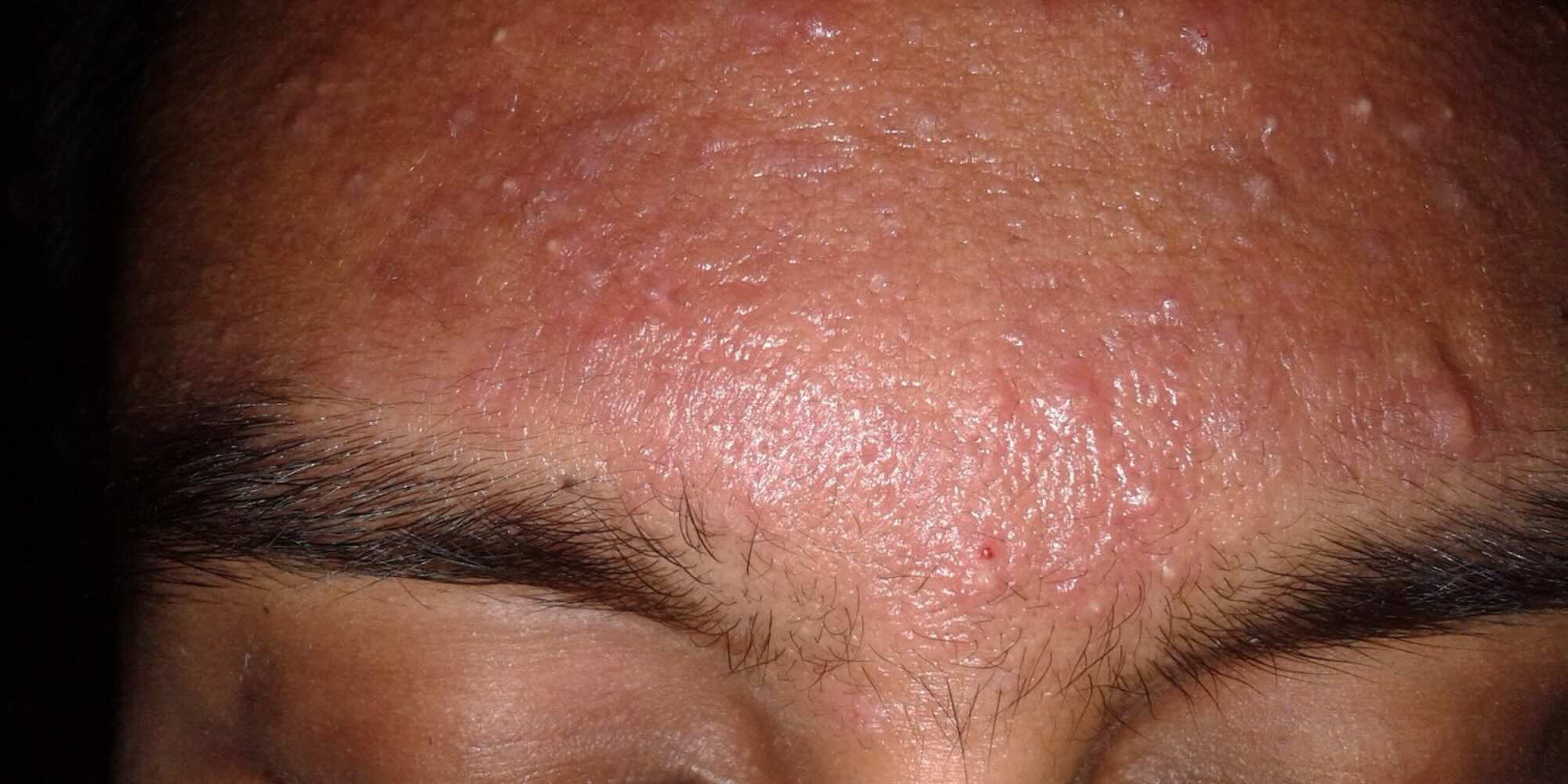 Letní horko a akné: proč se pupínky v létě zhoršují a co s tím?