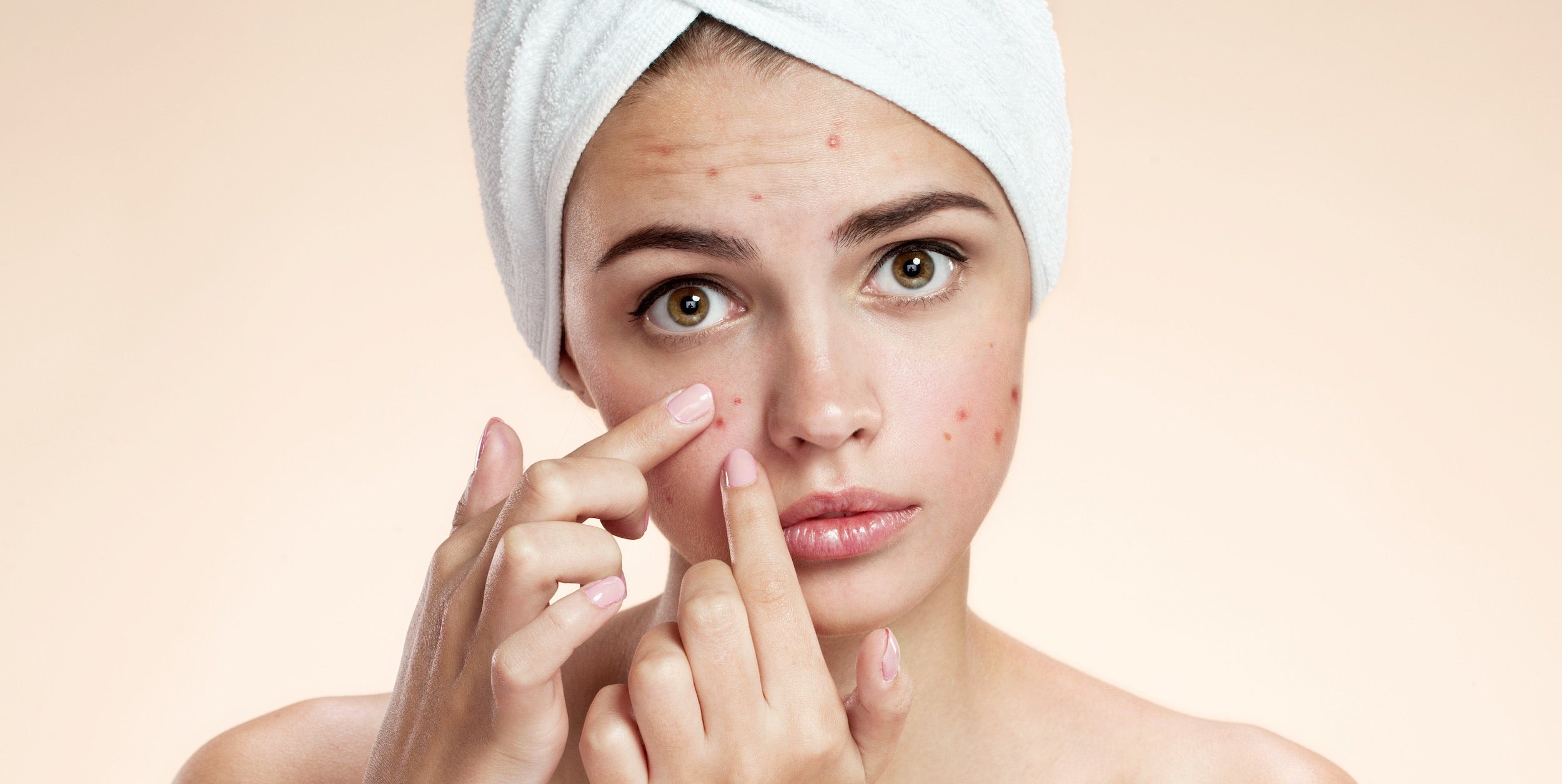 Woman wearing a towel with acne.