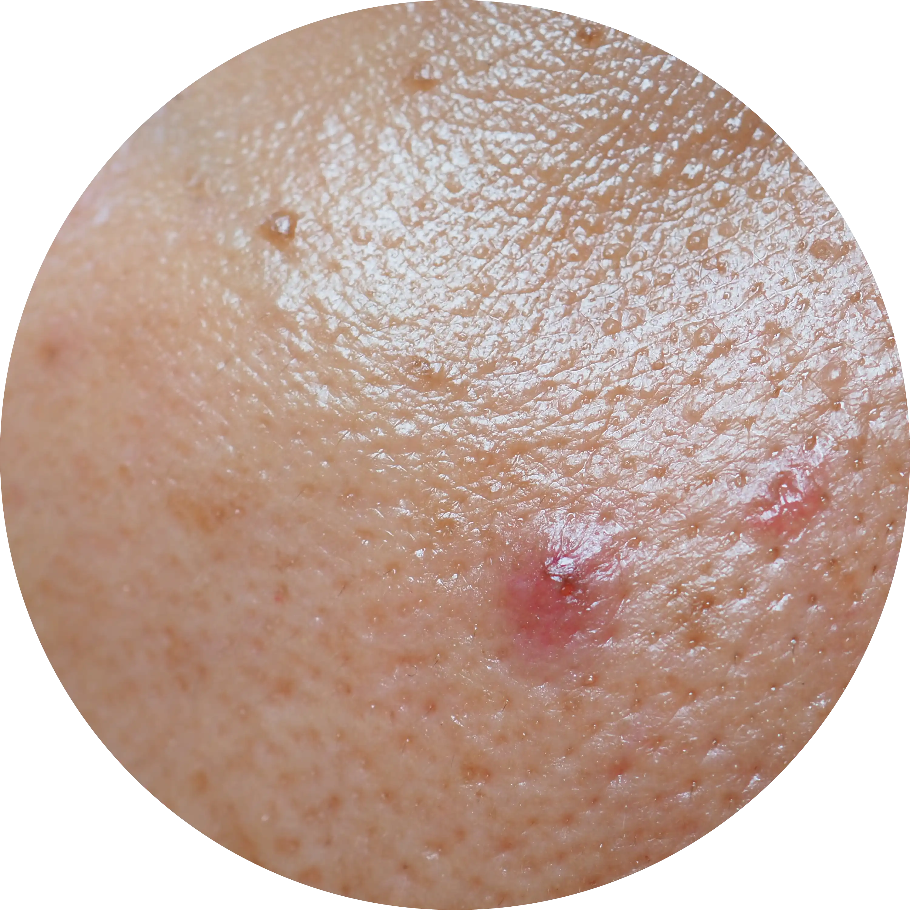 MASTNÁ PLEŤ (HYPERSEBORHEA)