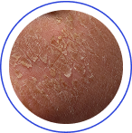 Oslabení lipidové bariéry