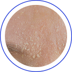 Suchá, napjatá pleť